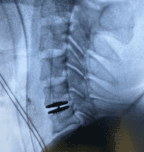 Artificial disc replacement xray